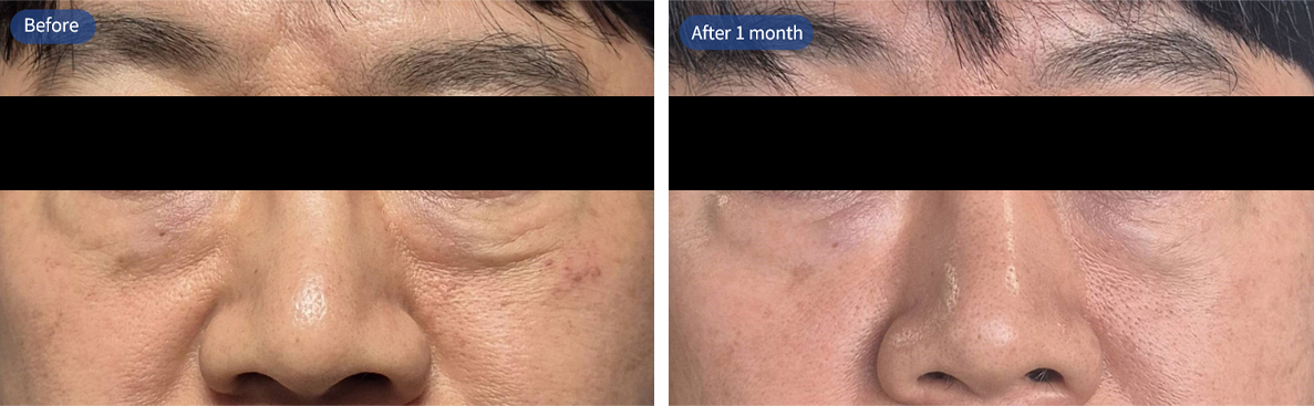 런치타임 눈밑 레이저