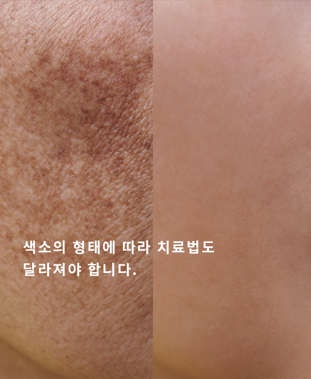 검버섯.베커모반.밀크반점