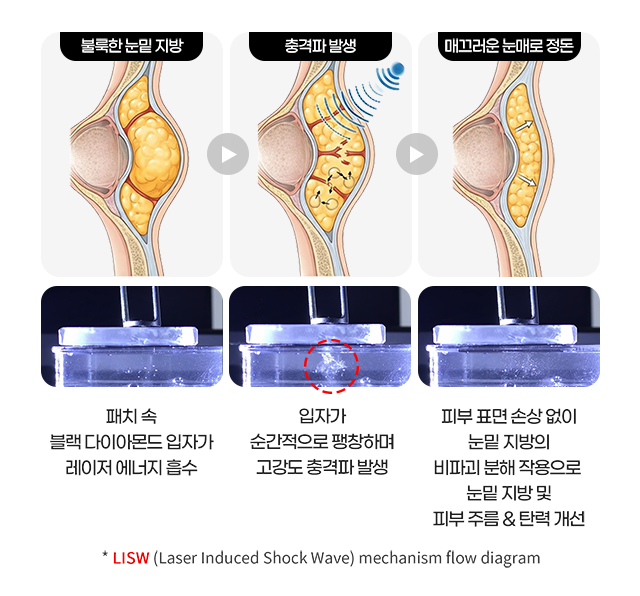 런치타임 눈밑 레이저