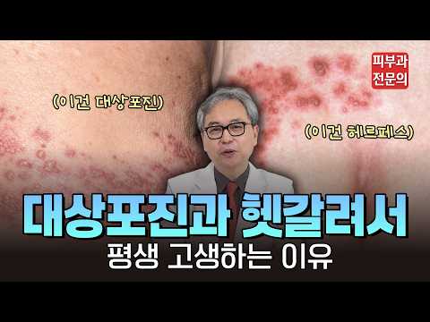 단순히 피곤해서 생긴 물집이 아니라고?" 피부과 전문의가 말하는 단순포진과 대상포진의 결정적 차이 #대상포진 #헤르페스 #단순포